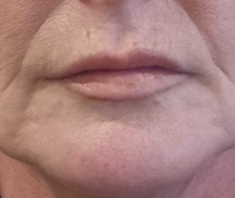 How do you know you’re ready for dermal fillers? After